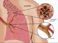 پاورپوینت بیماریهای مزمن انسدادی ریه COPD